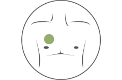 Implanted-Ports-APHERESIS.png