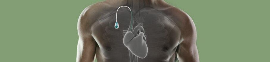 apheresis-what-is-a-port-768x0-c-default.png