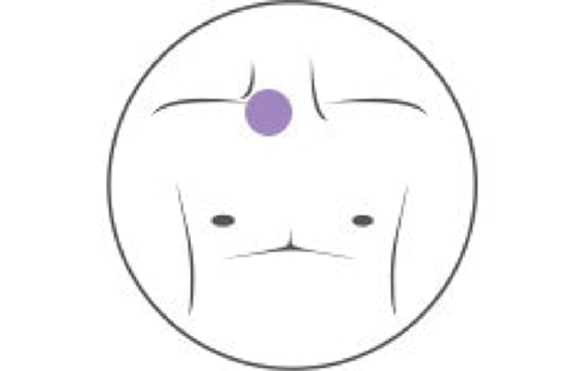 Tunneled-Central-Venous-Catheter-Chronic-CVCs_resized.png