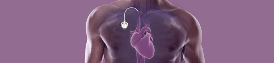 infusion-what-is-a-port-768x0-c-default-01.png